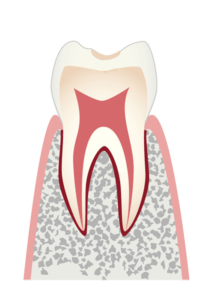 エナメル質＝歯の表面の虫歯